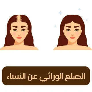 الصلع الوراثي عند النساء