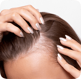 إمراءة تعاني من تراجع خط الشعر زراعة الشعر بتقنية السفير
