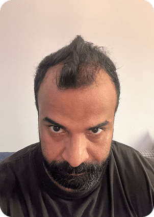 قبل وبعد زراعة الشعر في تركيا