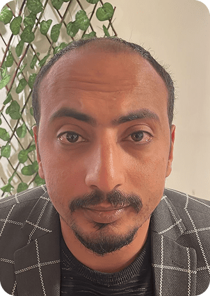 قبل وبعد زراعة الشعر في تركيا