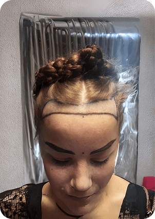 قبل وبعد زراعة الشعر للنساء في تركيا