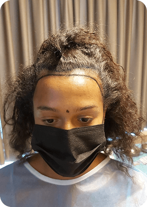 قبل وبعد زراعة الشعر للنساء في تركيا