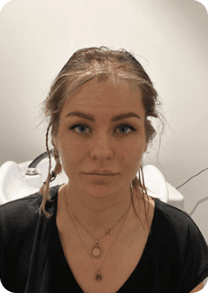 قبل وبعد زراعة الشعر للنساء في تركيا