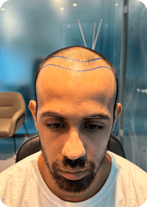 قبل وبعد زراعة الشعر في تركيا