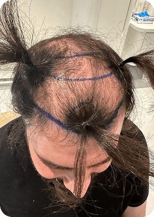 قبل وبعد زراعة الشعر في تركيا