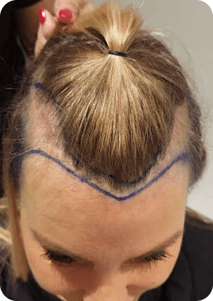 قبل وبعد زراعة الشعر للنساء في تركيا