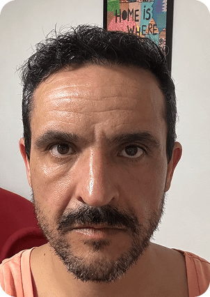 قبل وبعد زراعة الشعر في تركيا