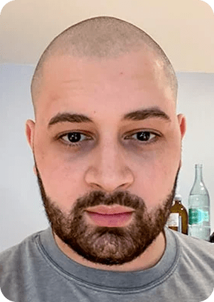 قبل وبعد زراعة اللحية في تركيا
