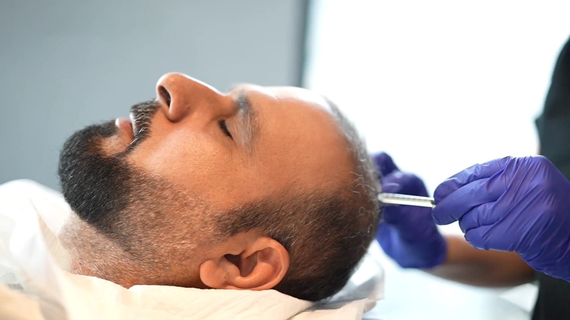 حقن البلازما بعد زراعة الشعر خليل البلوشي