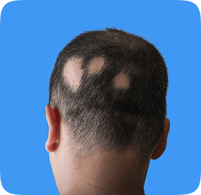 شخص يعاني من الثعلبة البقعية في مركز زراعة الشعر